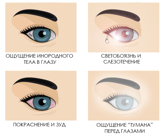 Симптомы синдрома сухого глаза