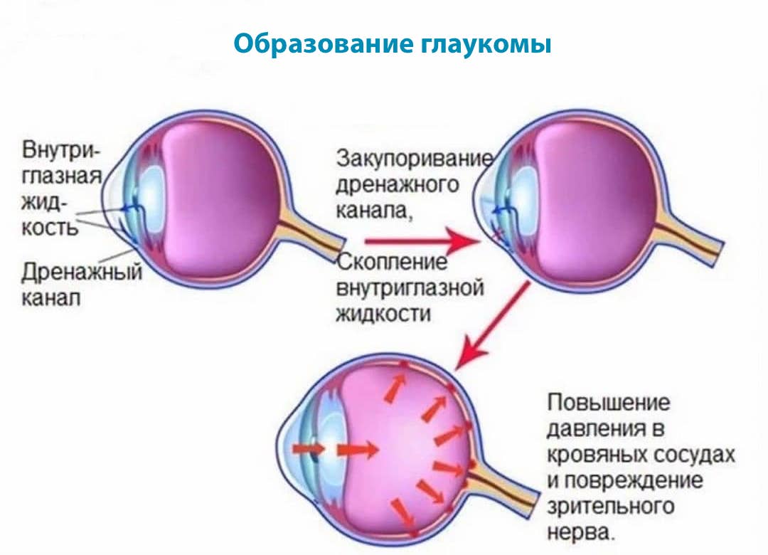 Образование глаукомы