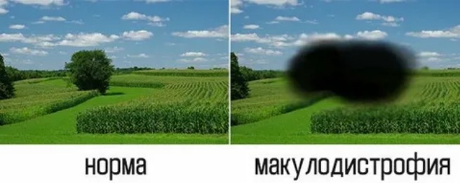 Симптомы макулодистрофии сетчатки