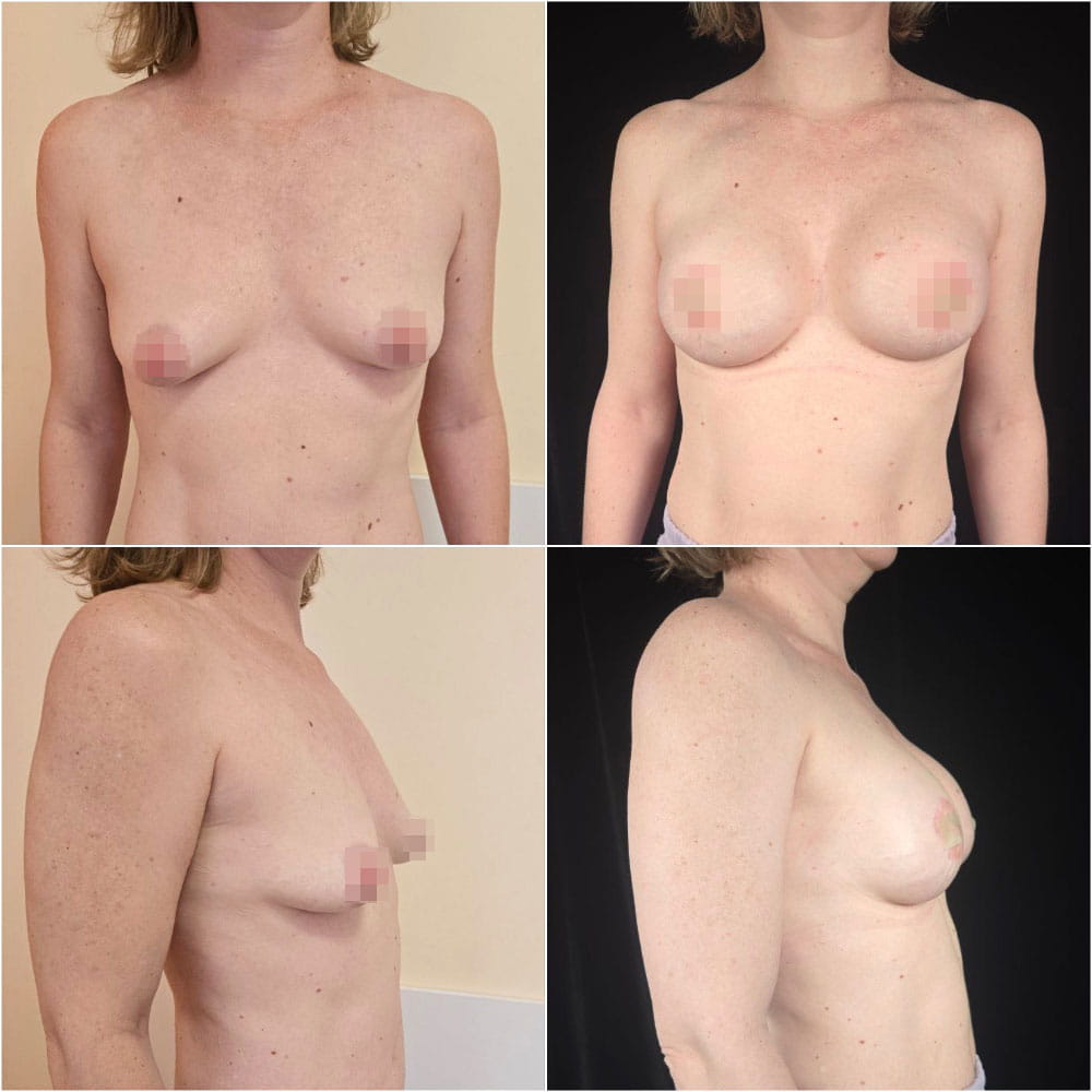 Результат операции по увеличению груди с помощью имплантов в ОН КЛИНИК – фото до и после