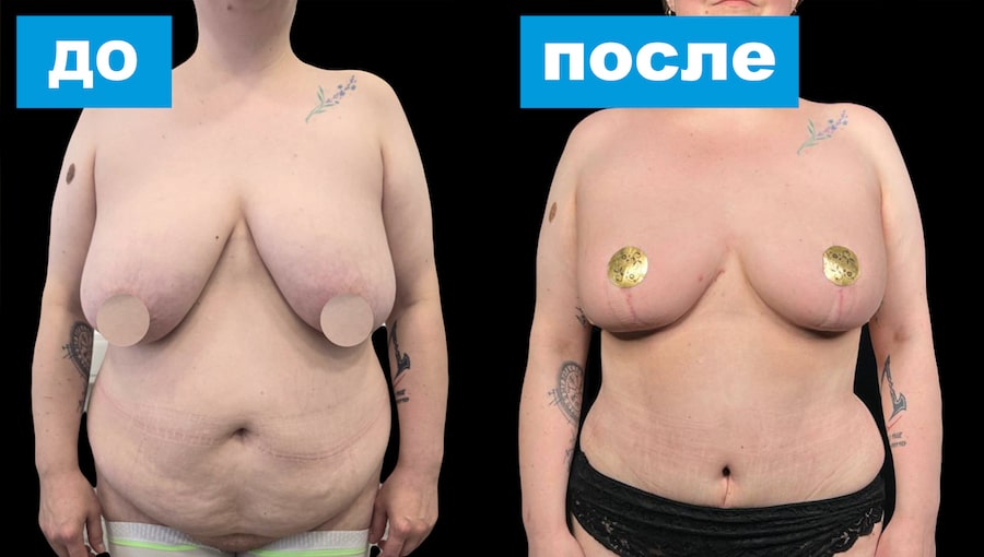 Мастопексия, абдоминопластика с ушиванием диастаза и переносом пупка, липосакция