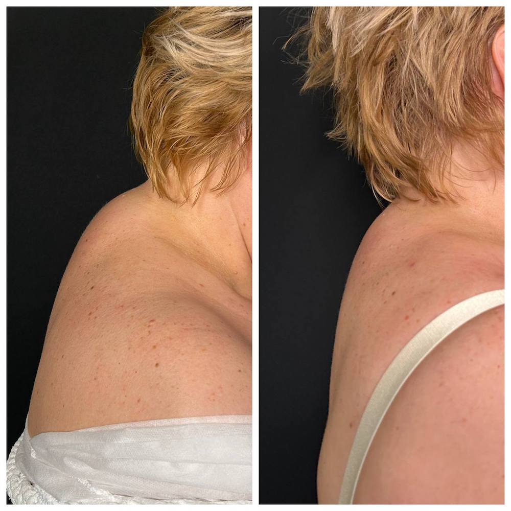 Липосакция холки: результат операции. Пластический хирург ОН КЛИНИК Тарасов Максим Дмитриевич