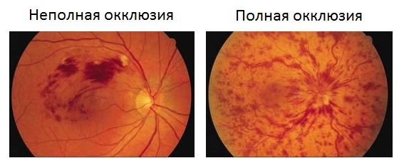 Полная и неполная окклюзия сетчатки глаза