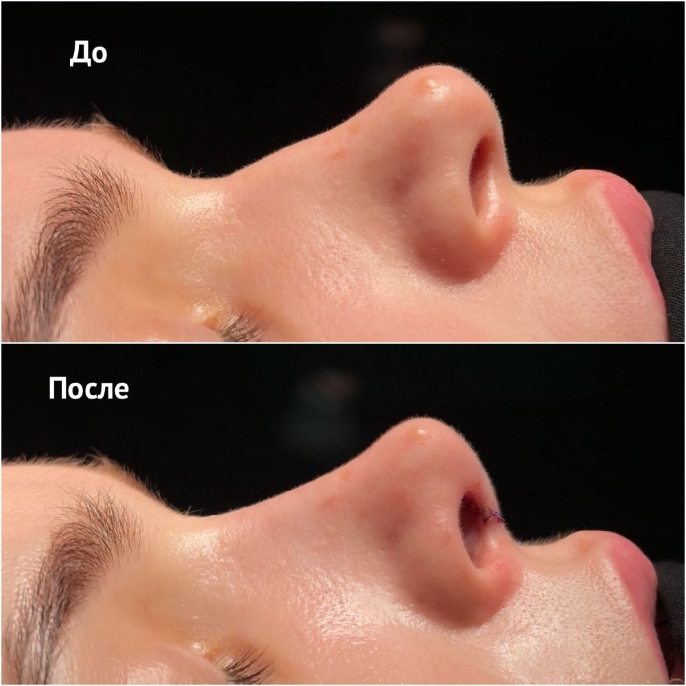 Риносептопластика. Хирург Ким Д.С. Фото до и после операции Риносептопластика. Хирург Ким Д.С. Фото до и после операции