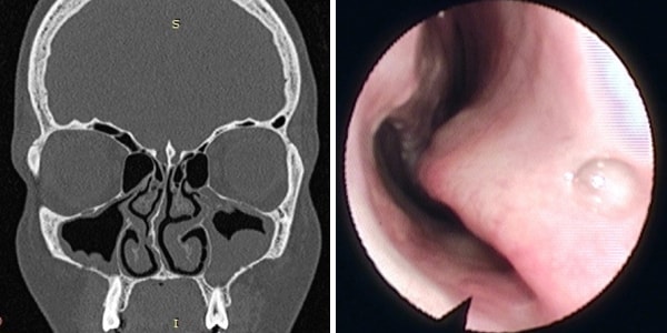 Хронический двусторонний верхнечелюстной синусит на фоне искривления носовой перегородки
