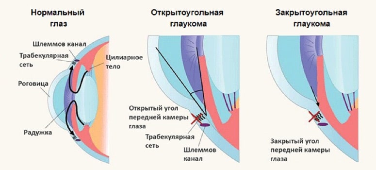 Открытоугольная и закрытоугольная глаукома