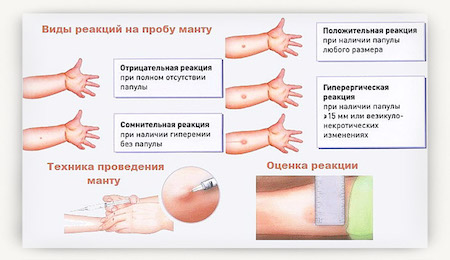 Картинки по запросу "фото результат Реакции Манту"