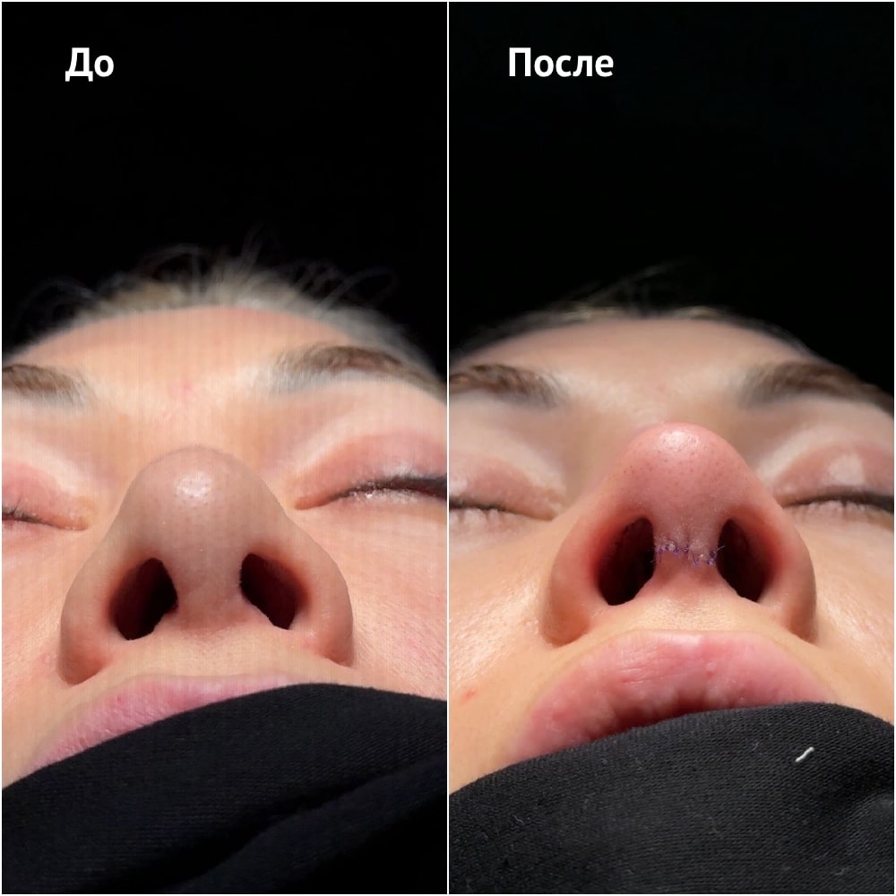 Повторная ринопластика. Хирург Ким Д.С. Фото до и после операции