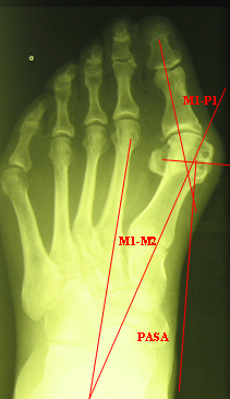 Рентгеновский снимок стопы при вальгусной деформации