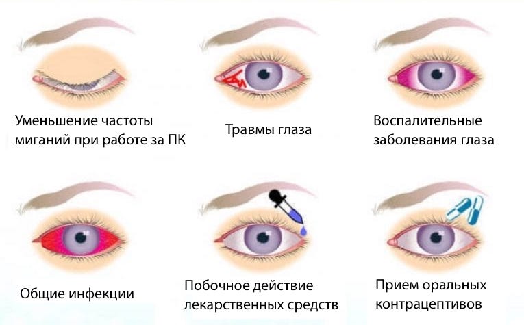 Причины возникновения синдрома сухого глаза