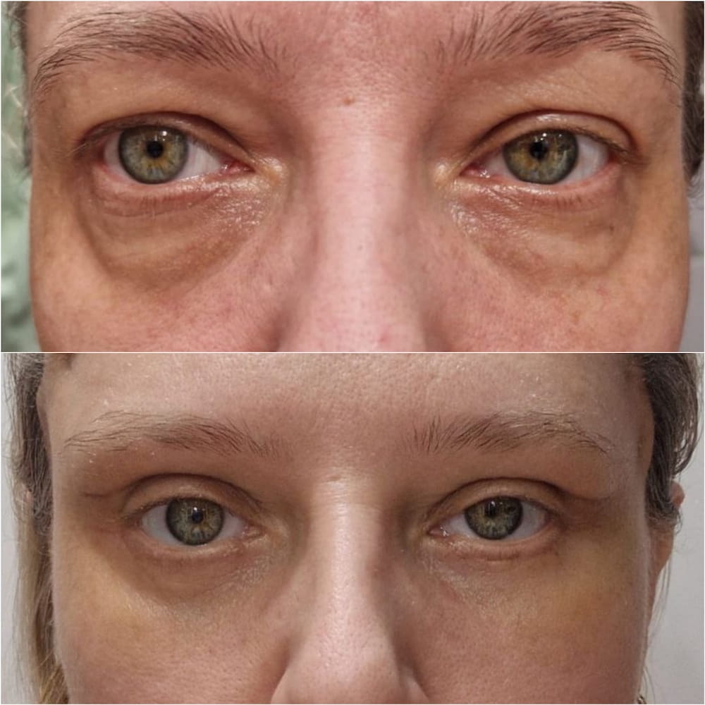 Результат операции – круговая блефаропластика с фиксацией бровей. Пластический хирург ОН КЛИНИК Зиятдинов Халиль Камилевич