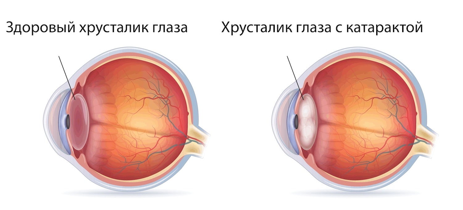 Катаракта хрусталика глаза