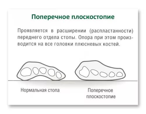 poperechnoe-ploskostopie-02.jpeg