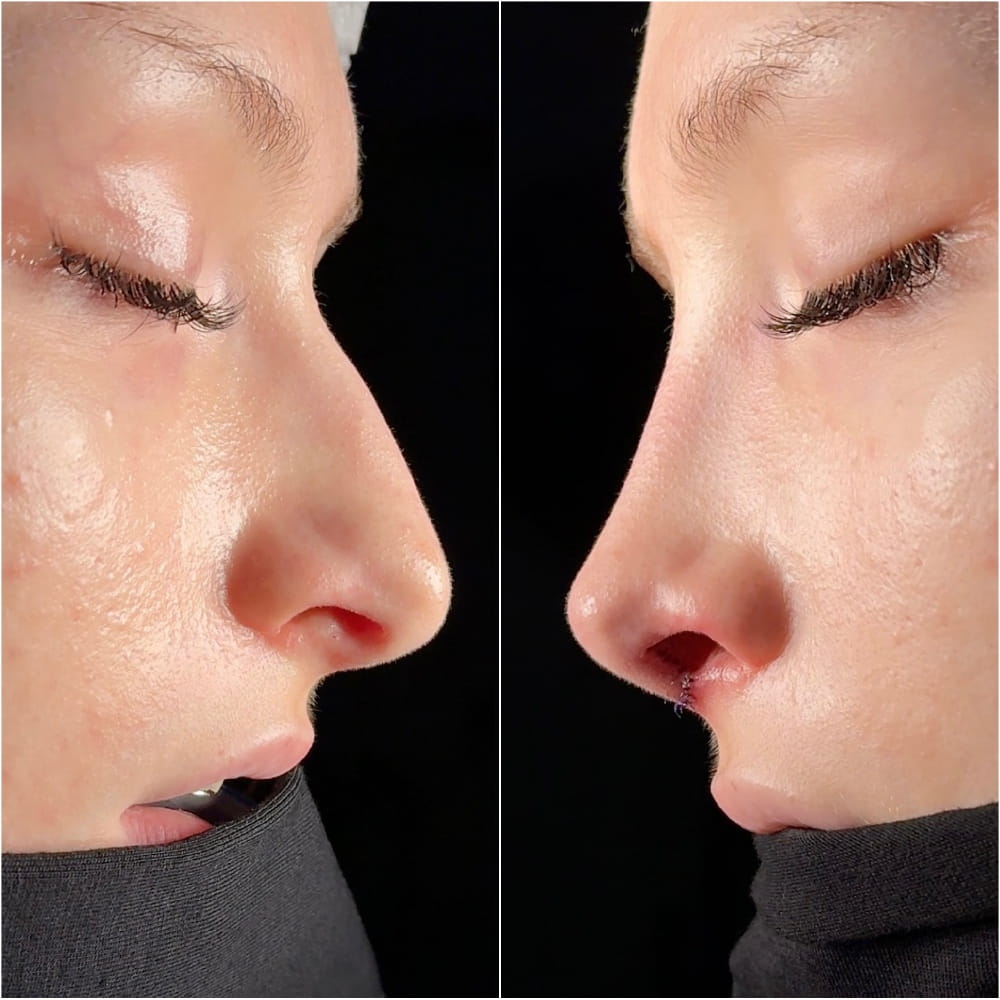Сохраняющая ринопластика – фото до и после операции