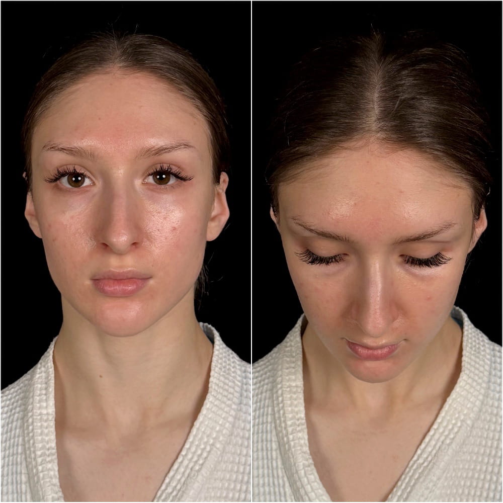 Сохраняющая ринопластика – фото пациентки ОН КЛИНИК до операции