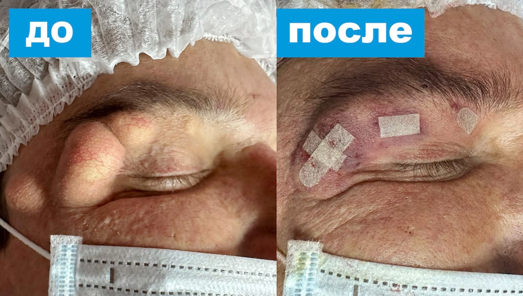 Удаление новообразований века радиоволновым ножом в ОН КЛИНИК: фото до и после