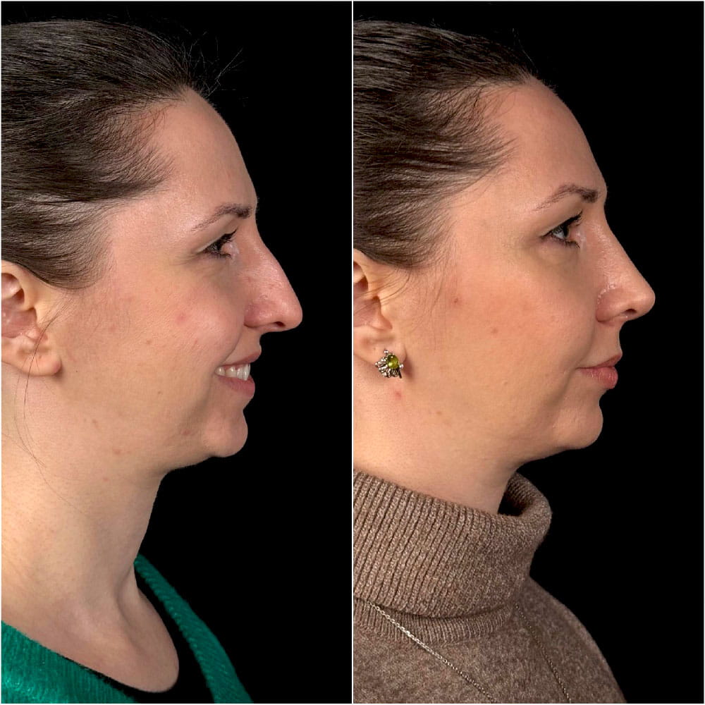 Результат ринопластики – фото до и спустя 4 месяца после операции