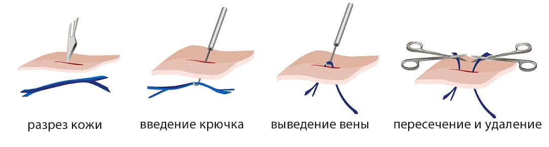 Минифлебэктомия микрофлебэктомия