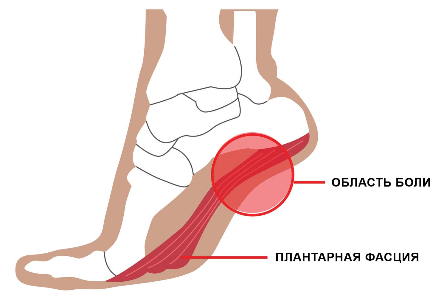Пяточная шпора Пяточная шпора