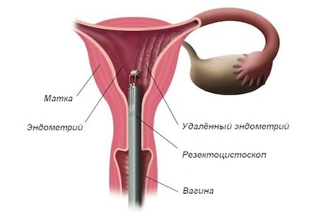Аблация эндометрия в ММЦ ОН КЛИНИК Аблация эндометрия