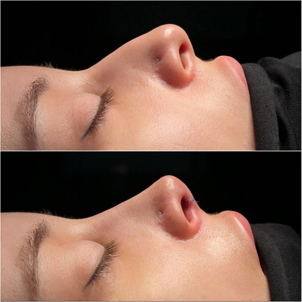 Риносептопластика: фото до и после из операционной. Пластический хирург Ким Д.С.