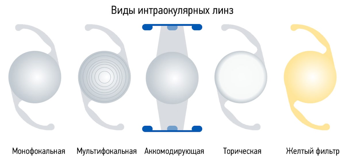 Виды интраокулярных линз