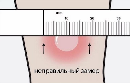 Фото Манту У Ребенка 1 Год