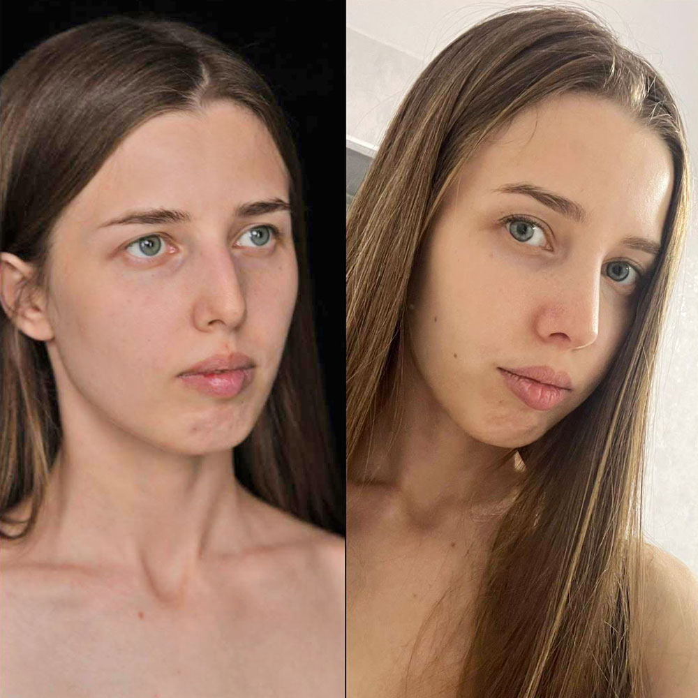 Ринопластика. Хирург Ким Д.С. Фото до и после операции
