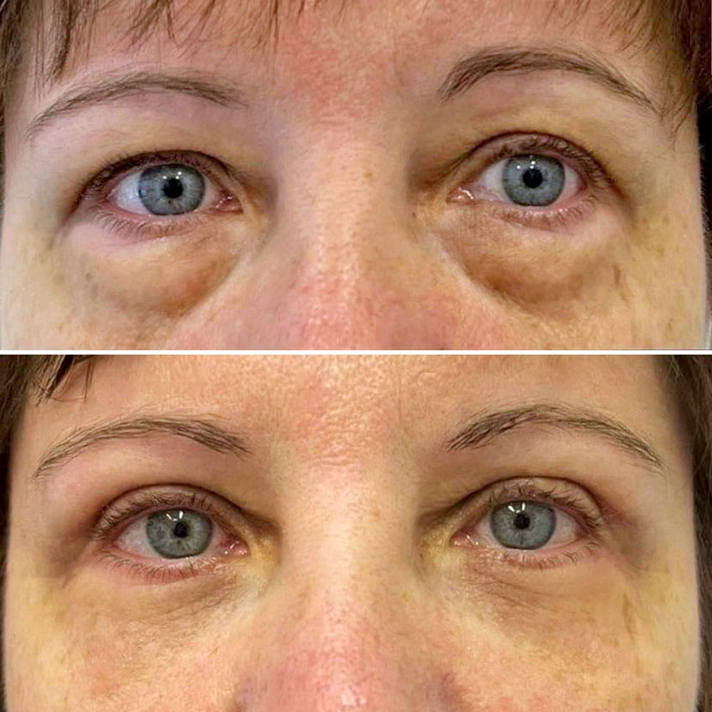 Результат операции по омоложению век – фото до и после. Пластический хирург ОН КЛИНИК Семенова Юлия Игоревна