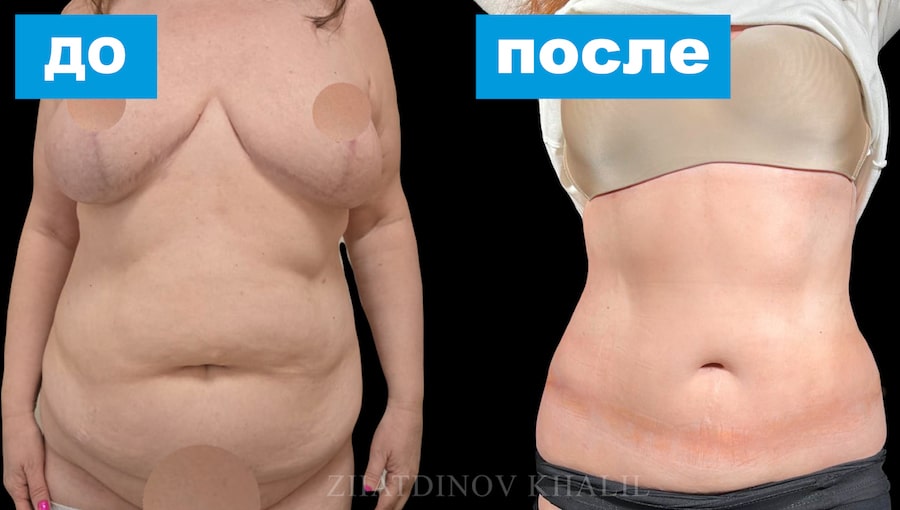 Абдоминопластика с ушиванием диастаза плюс липосакция 360 градусов
