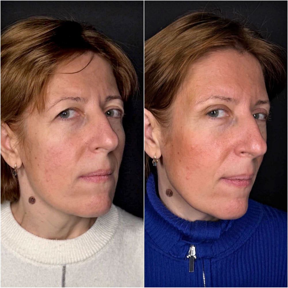 Верхняя блефаропластика – фото до и после операции. Пластический хирург ОН КЛИНИК Семенова Юлия Игоревна