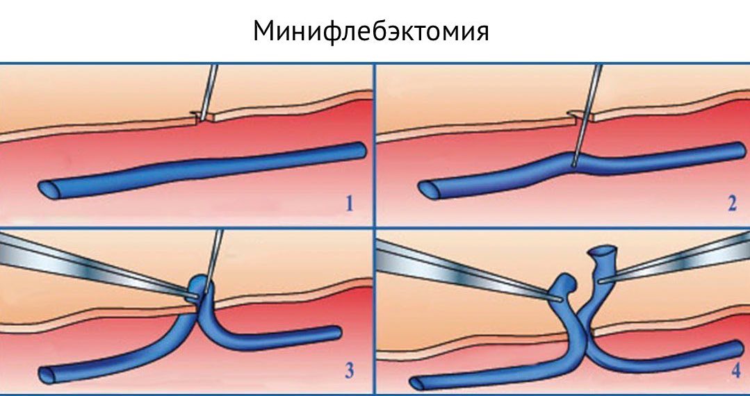 Минифлебэктомия при варикозе