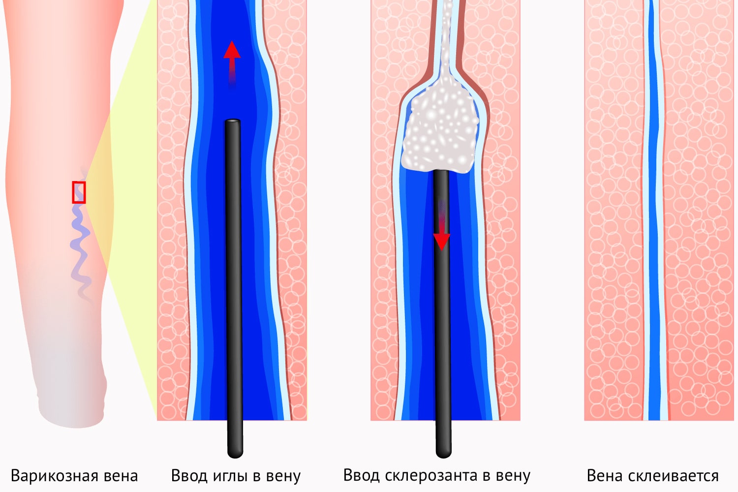 Склеротерапия при варикозе