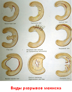Виды разрывов мениска