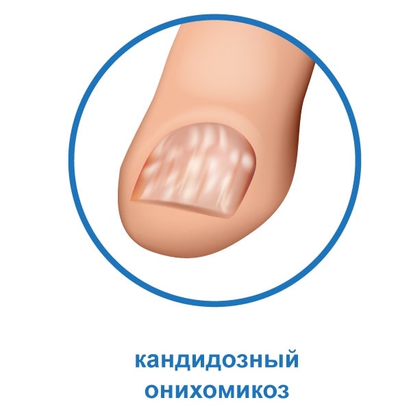 Кандидозный онихомикоз Кандидозный онихомикоз