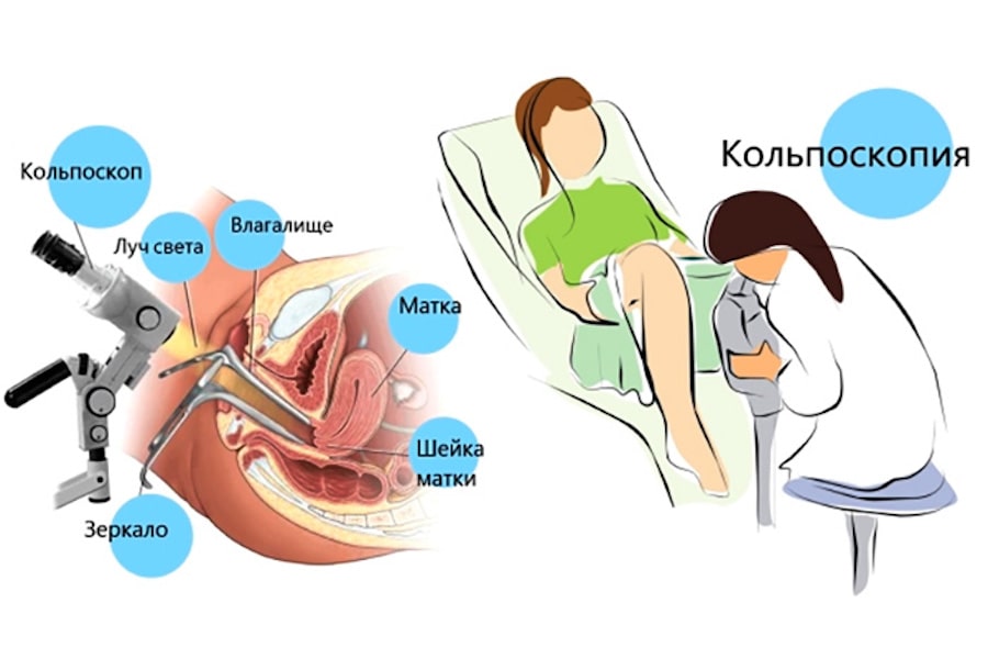 Кольпоскопия Кольпоскопия