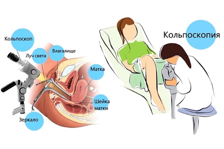 Кольпоскопия