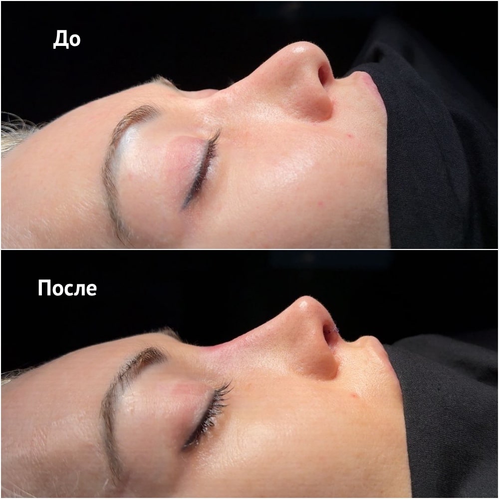 Повторная ринопластика. Хирург Ким Д.С. Фото до и после операции