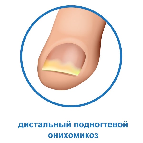 Дистальный подногтевой онихомикоз