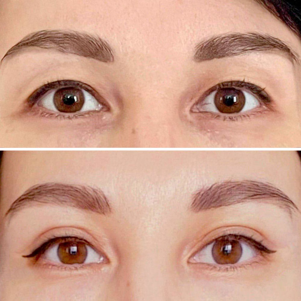 Результат операции по пластике азиатских век – фото до и спустя 2 месяца после операции. Пластический хирург ОН КЛИНИК Семенова Юлия Игоревна