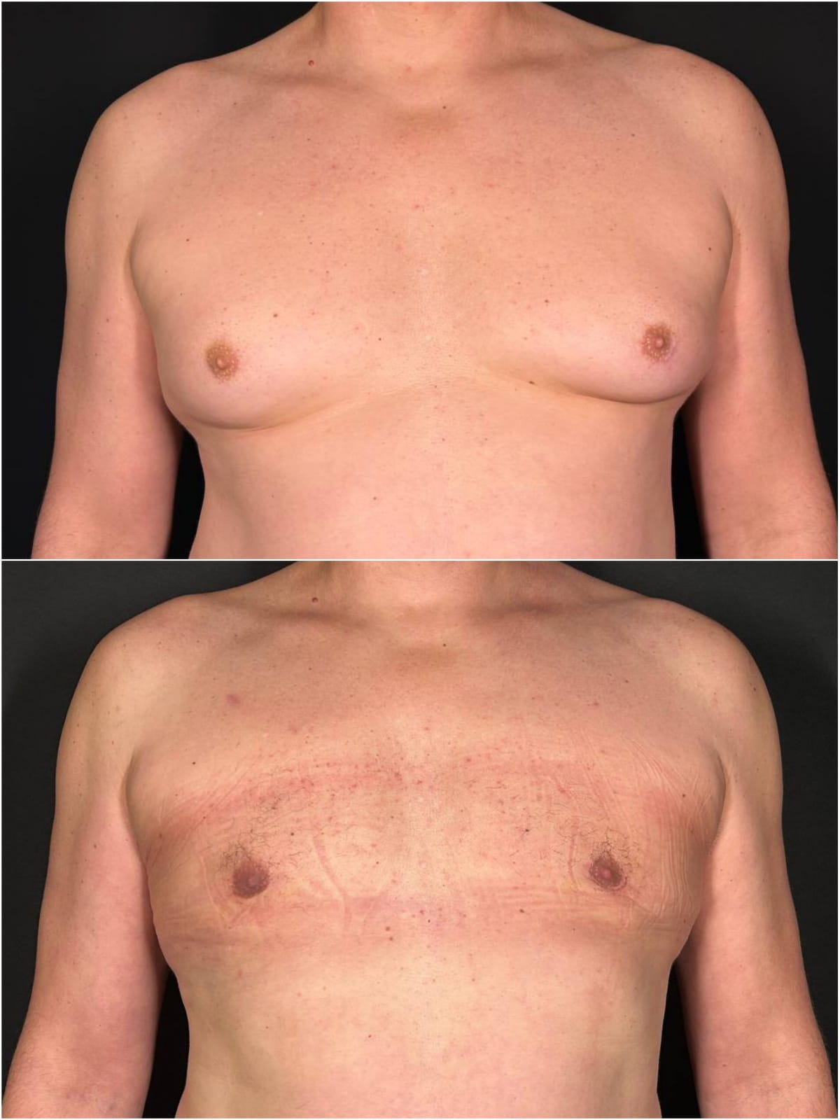 Результат операции по коррекции гинекомастии – фото до и после. Пластический хирург ОН КЛИНИК Тарасов Максим Дмитриевич