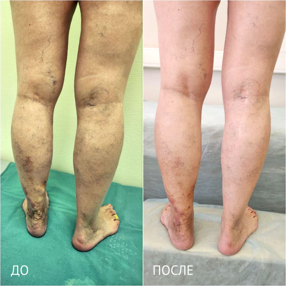 Результаты операции по лечению варикоза – фото до и через месяц после операции. Флеболог ОН КЛИНИК Кубанова Радмила Руслановна