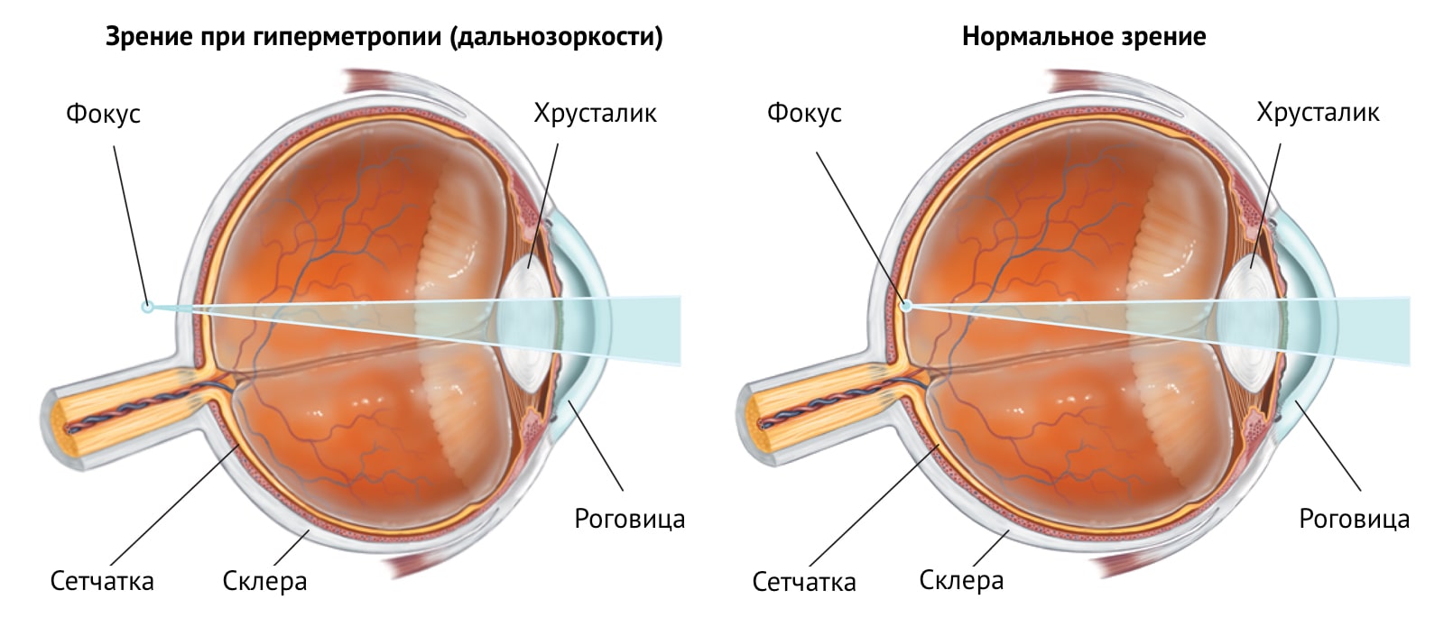 Transicion cetosis