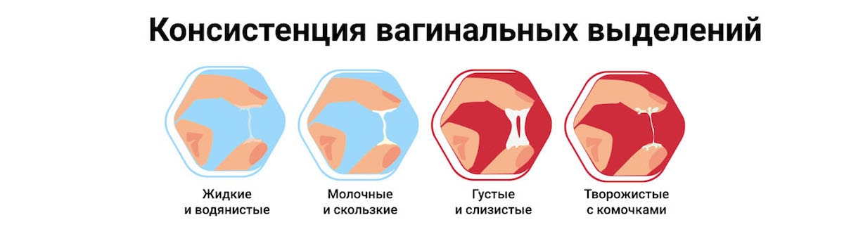Выделения из влагалища - виды, причины и лечение Белые выделения