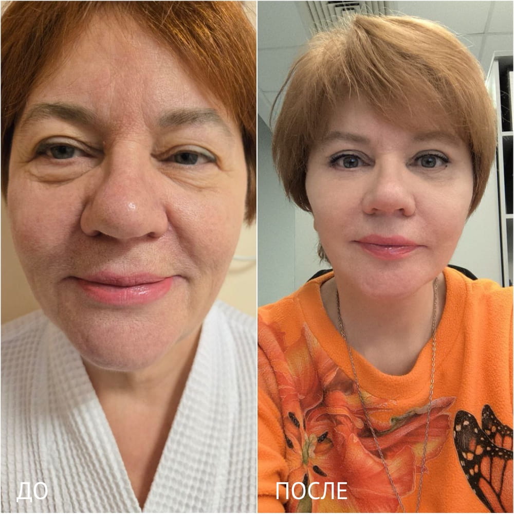 Результат операции по композитному лифтингу – фото до и после. Пластический хирург ОН КЛИНИК Зиятдинов Халиль Камилевич