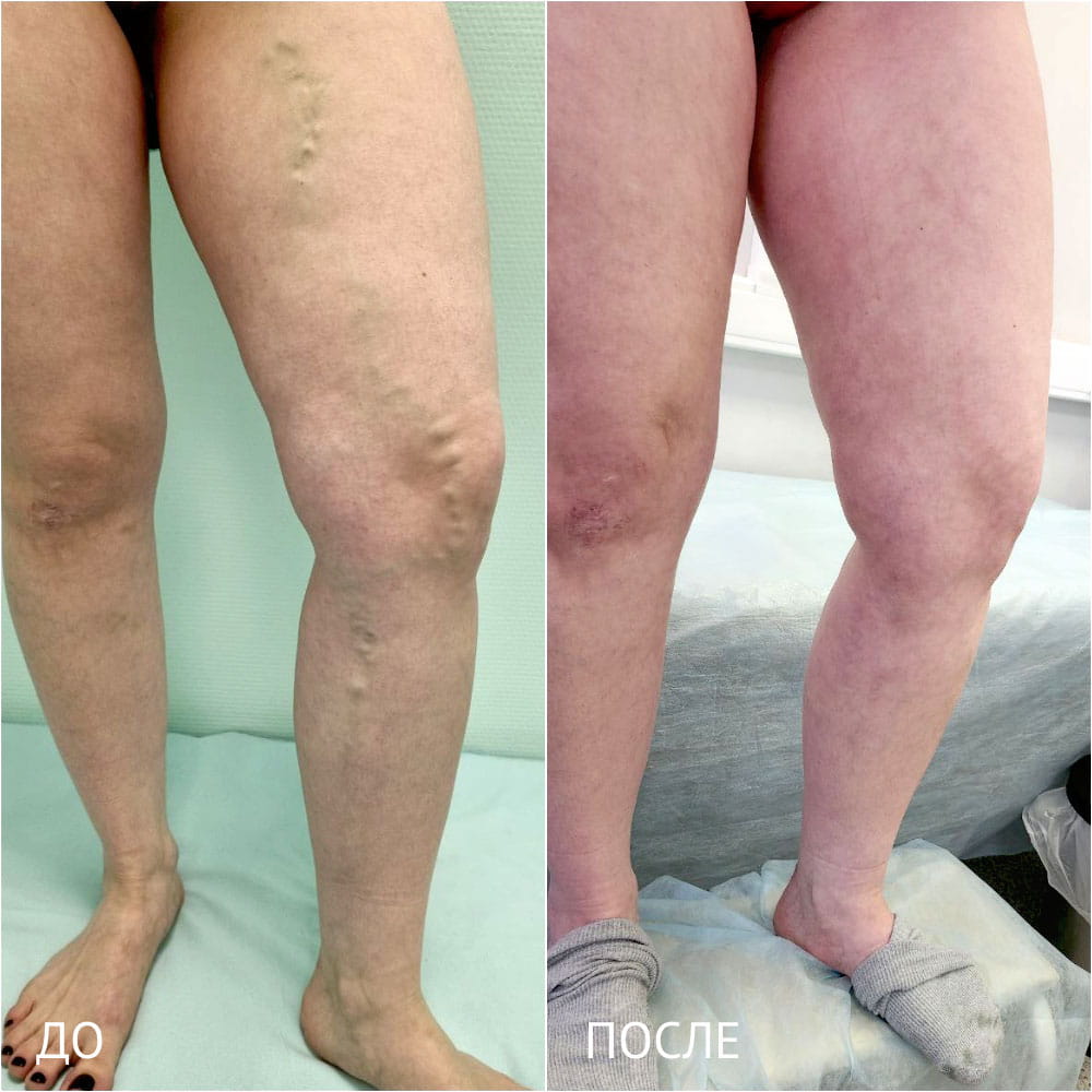 Результаты операции по лечению варикоза – фото до и через месяц после операции. Флеболог ОН КЛИНИК Кубанова Радмила Руслановна