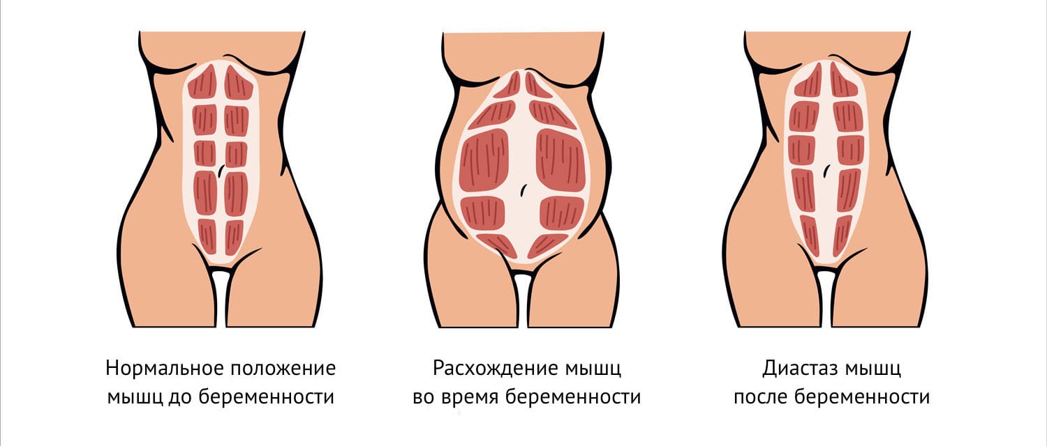 Диастаз прямых мышц живота после родов