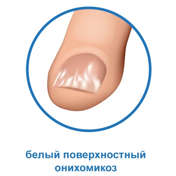 Белый поверхностный онихомикоз Белый поверхностный онихомикоз