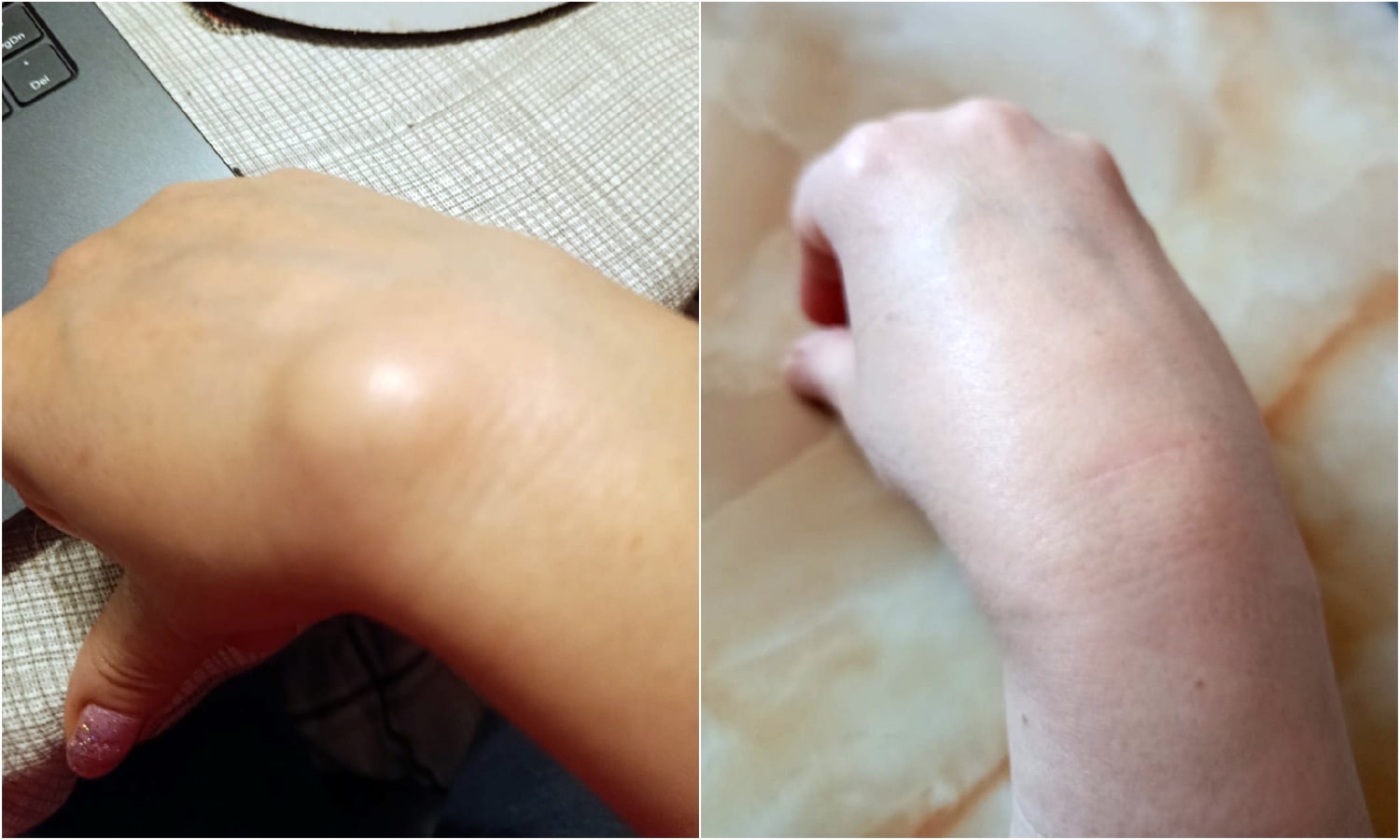 Результат хирургического лечения гигромы запястья: фото до и после операции