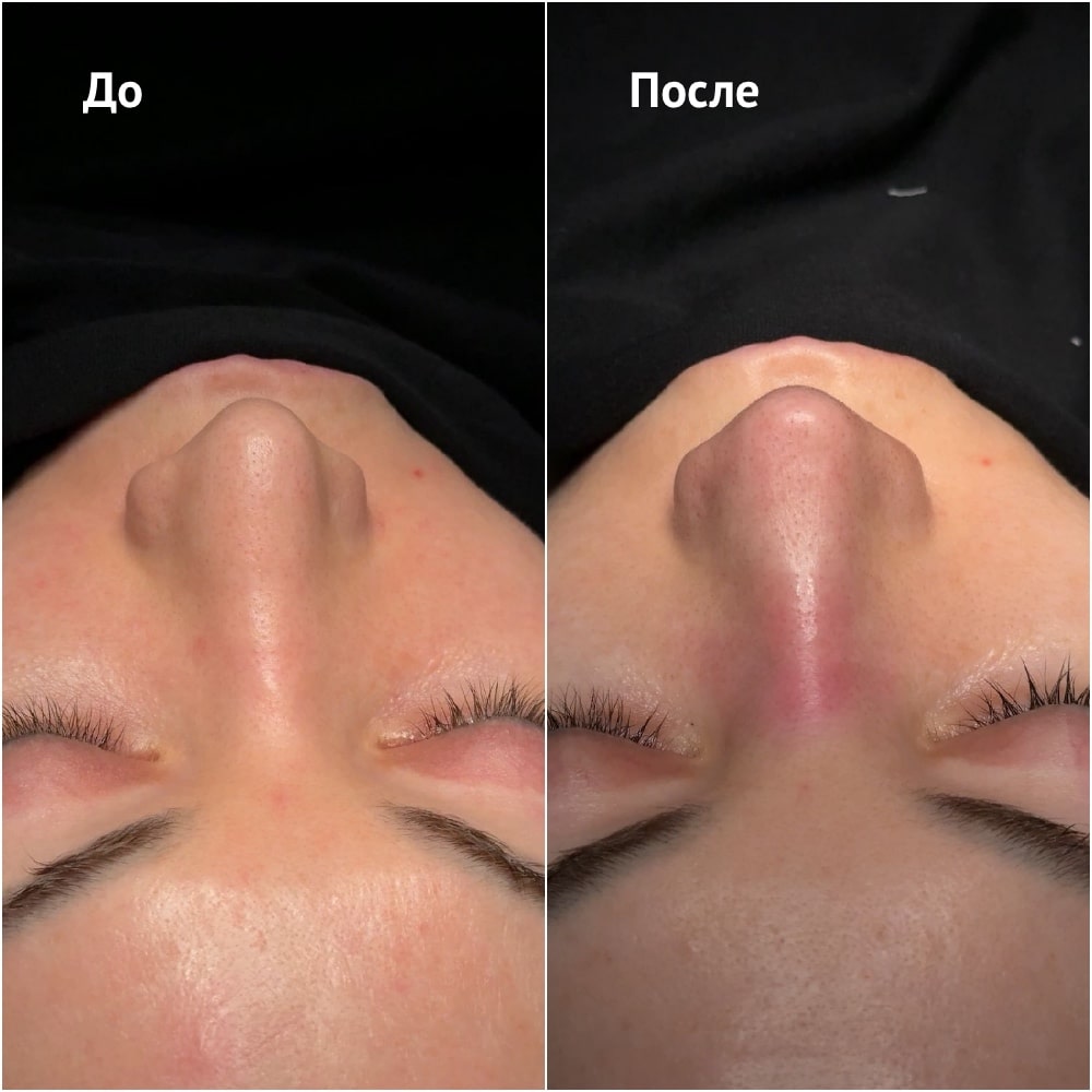 Повторная ринопластика. Хирург Ким Д.С. Фото до и после операции